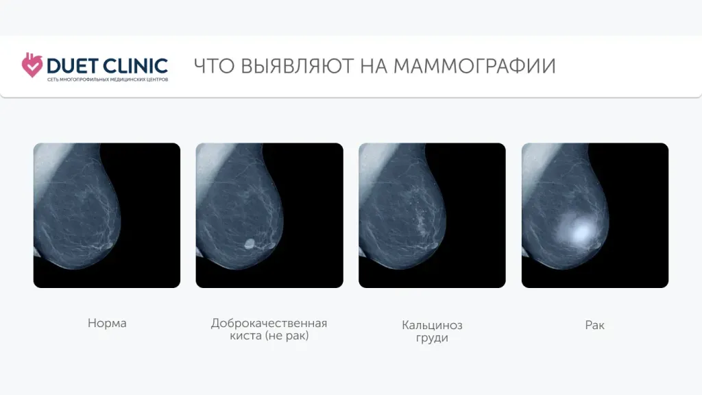 75% случаев рака груди у нижегородок выявляют на ранних стадиях